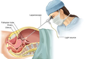 laparoscopy endoscopy surgery